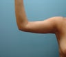 47 Year Old Female Treated for Excess Arm Skin