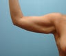 47 Year Old Female Treated for Excess Arm Skin