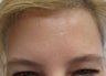 40 year-old female treated with Botox for frown lines