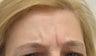40 year-old female treated with Botox for frown lines