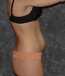 Vaser Lipsuction
