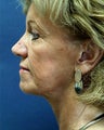 face/neck lift