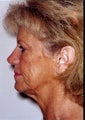face/neck lift