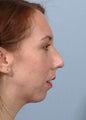 Female Chin Implant