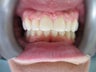 Goofy teeth, large overbite/overjet