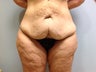 Tummy Tuck