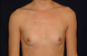 Breast Augmentation