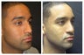 Rhinoplasty