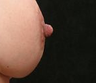 Nipple Surgery