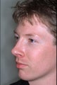 Rhinoplasty