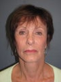Brow Lift, Fat Transfer, LiteLift™ on 62-year-old Woman