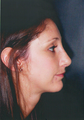Chin Augmentation