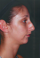 Chin Augmentation