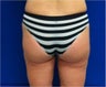 Laser Liposuction