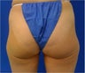Laser Liposuction