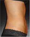 SmartLipo MPX with Pro-Sculpt