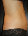 SmartLipo MPX with Pro-Sculpt