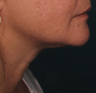 Ulthera
