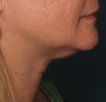 Ulthera