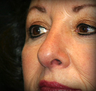 Rhinoplasty