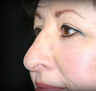 Rhinoplasty
