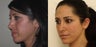 Fat transfer to improve facial balance