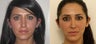 Fat transfer to improve facial balance