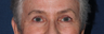 Ulthera Eyes | Before and After