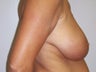 Patient with Breast Lift
