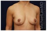 Breast Lift
