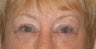 Upper and lower lid blepharoplasty, ptosis repair, chemical peel to lower lids