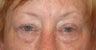 Upper and lower lid blepharoplasty, ptosis repair, chemical peel to lower lids