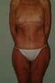 Total body makeover
