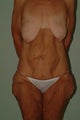 Total body makeover