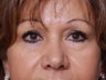 Brow Lift
