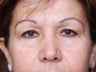 Brow Lift