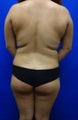 Brazilian Butt Lift