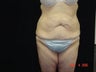 Body Lift with Liposuction of Abdomen, Waist, Flanks