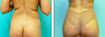 Liposuction Before & After