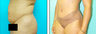 Liposuction Before & After