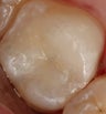 Restoration of Broken Tooth with Porcelain Onlay