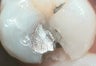 Restoration of Broken Tooth with Porcelain Onlay