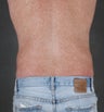CoolSculpting