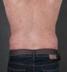 CoolSculpting