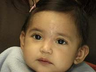 Forehead hemangioma surgery