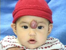 Forehead hemangioma surgery