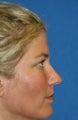 Lower Blepharoplasty and Fat Transfer