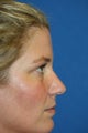 Lower Blepharoplasty and Fat Transfer