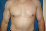 gynecomastia correction in a bodybuilder
