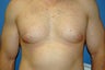 gynecomastia correction in a bodybuilder